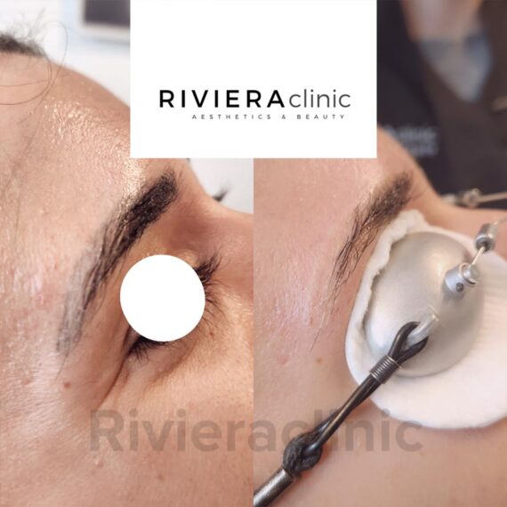 Résultat de détatouage laser des sourcils de la rivieraclinic Lausanne