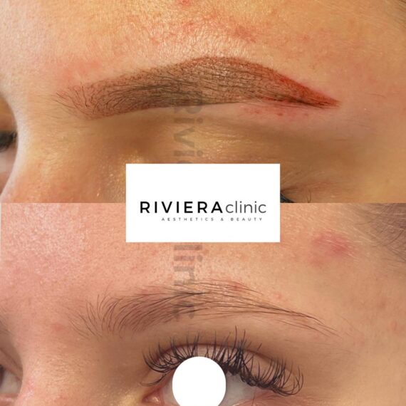 Résultat de détatouage laser des sourcils de la rivieraclinic Lausanne