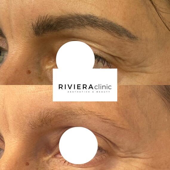 Résultat de détatouage laser des sourcils de la rivieraclinic Lausanne