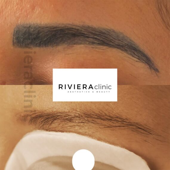 Résultat de détatouage laser des sourcils de la rivieraclinic Lausanne