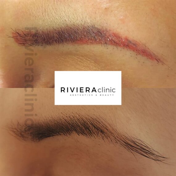 Résultat de détatouage laser des sourcils de la rivieraclinic Lausanne