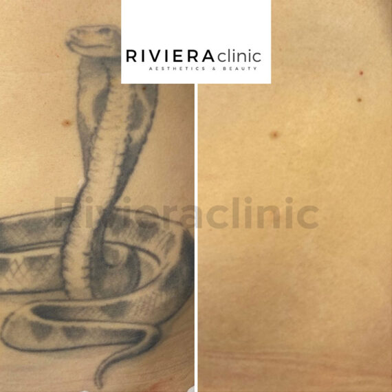 Résultat de détatouage laser de la rivieraclinic Lausanne