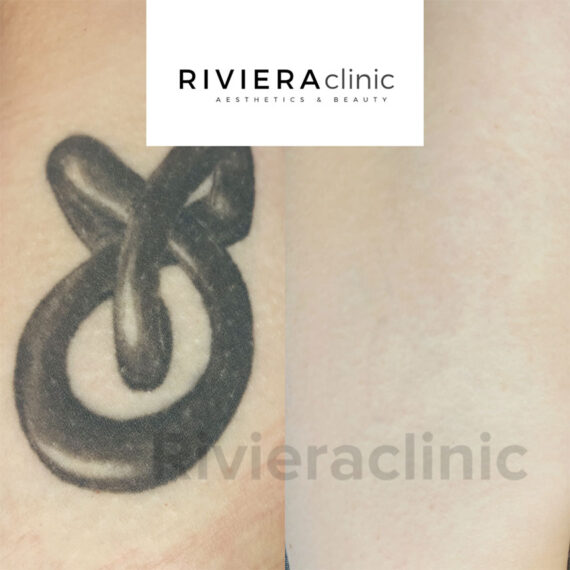 Résultat de détatouage laser de la rivieraclinic Lausanne