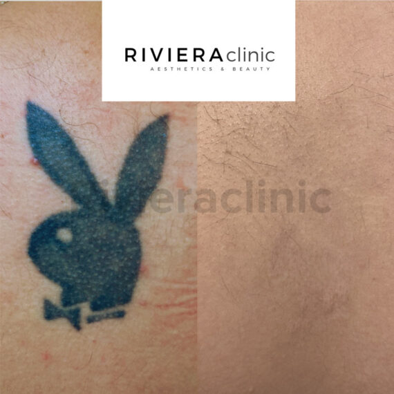 Résultat de détatouage laser de la rivieraclinic Lausanne