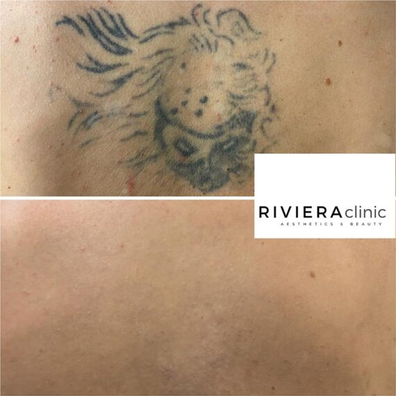 Résultat de détatouage laser de la rivieraclinic Lausanne