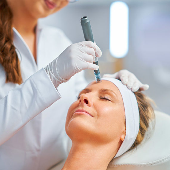 microneedling