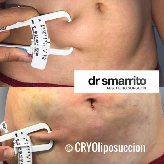 Résultat de cryolipossucion procédure inventeur par le Dr SMARRITO