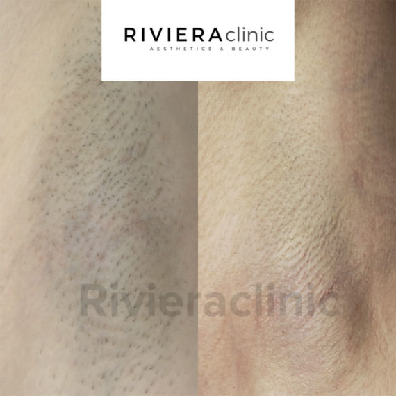 Résultat d'épilation laser des aisselles chez une femme. Epilation laser réalisée à la Rivieraclinic