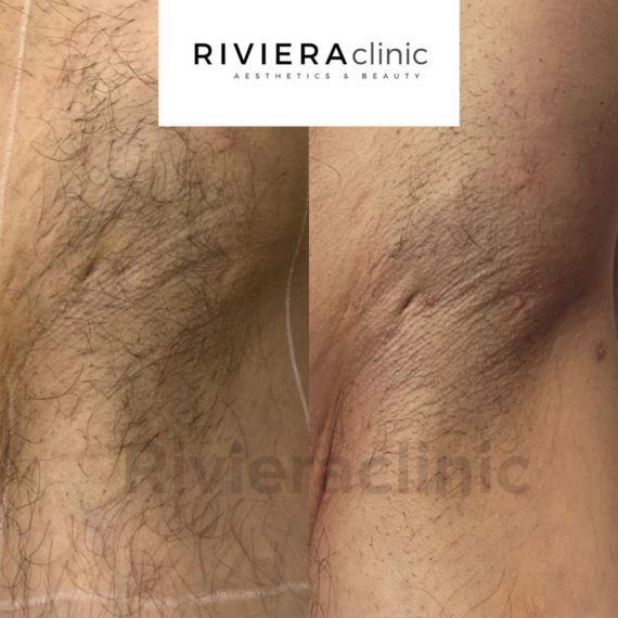 Résultat d'épilation laser des aisselles chez un homme. Epilation laser réalisée à la Rivieraclinic