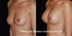Augmentation mammaire 80D